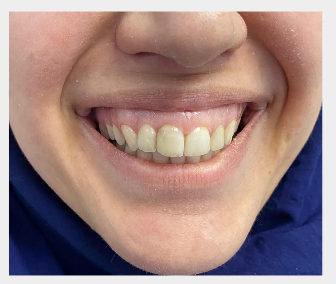 Gummy Smile Tedavisi Öncesi - Özel Astro Dent Ağız ve Diş Sağlığı Kliniği, Mardin